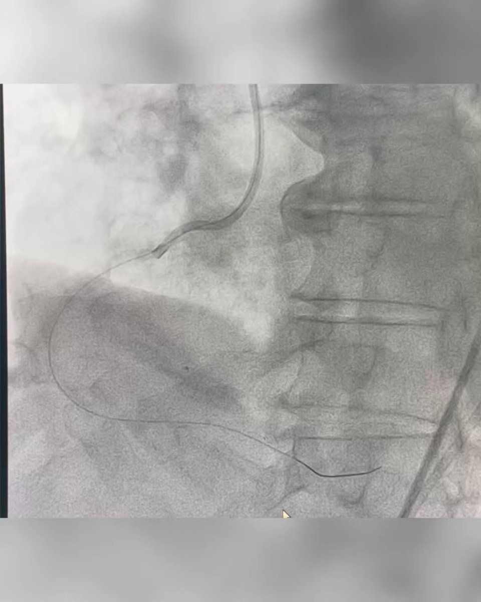Multivessel CTO angiography
