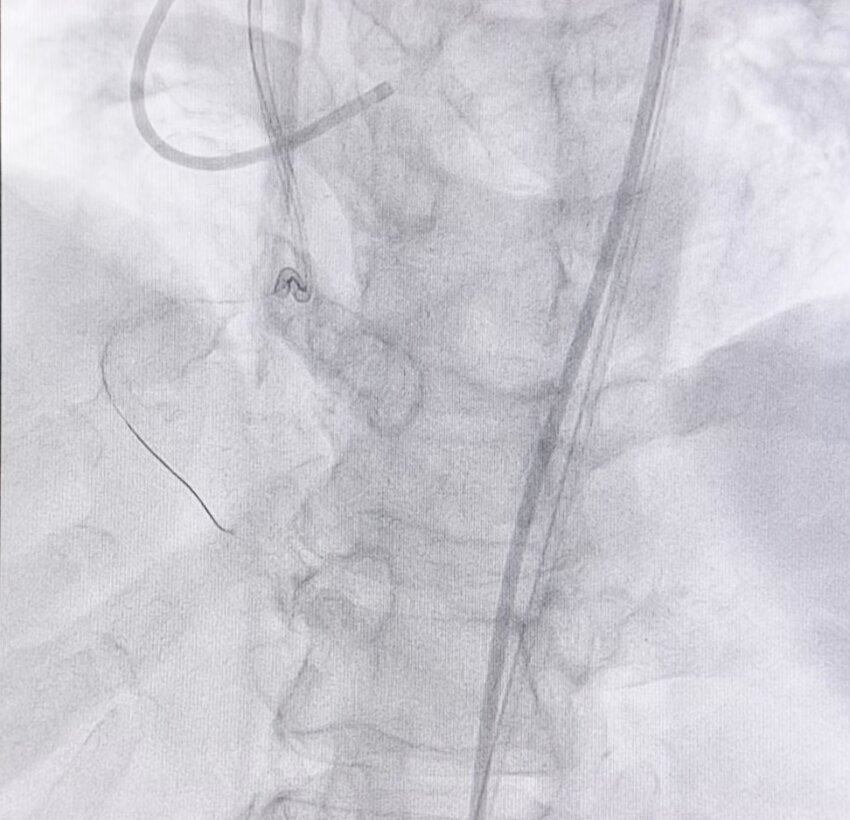 RCA CTO with rotational atherectomy