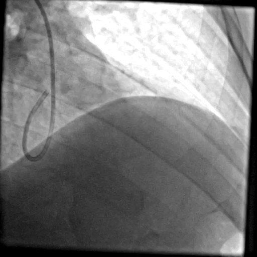 LAD CTO antegrade wire escalation