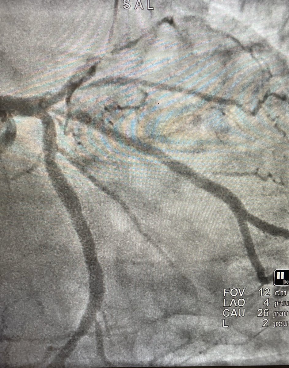 LAD proximal CTO with LM trifurcation, angiographic image