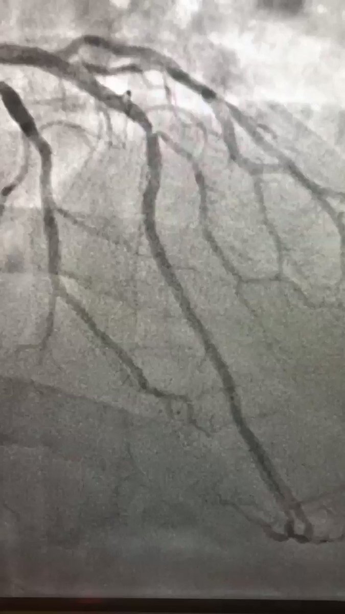 LAD/Dg bifurcation, reverse wire technique