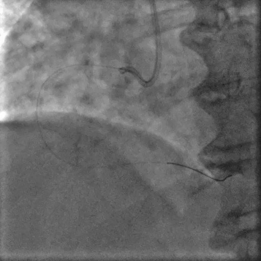 Calcified lesion with coronary laceration, Ping-Pong bailout