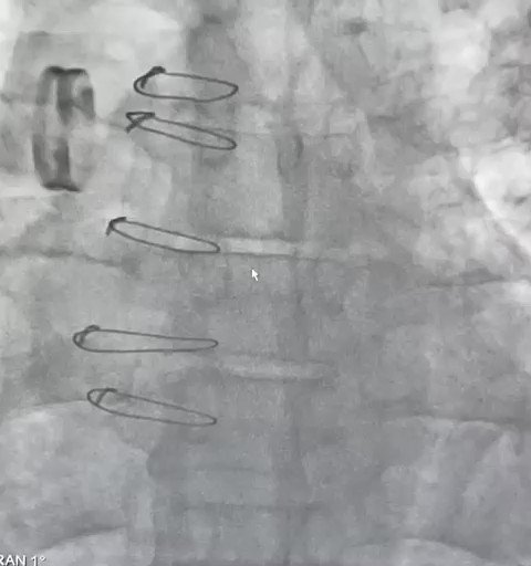 Mechanical SAVR with acute decompensation, emergent cath