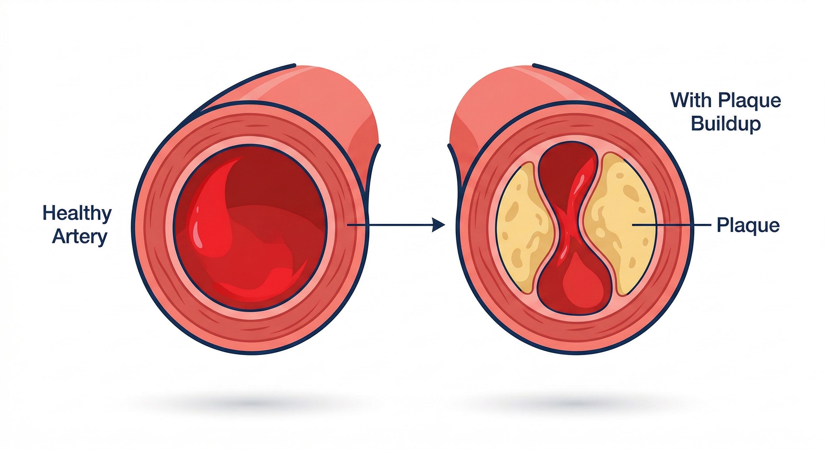 Healthy artery vs artery with plaque buildup