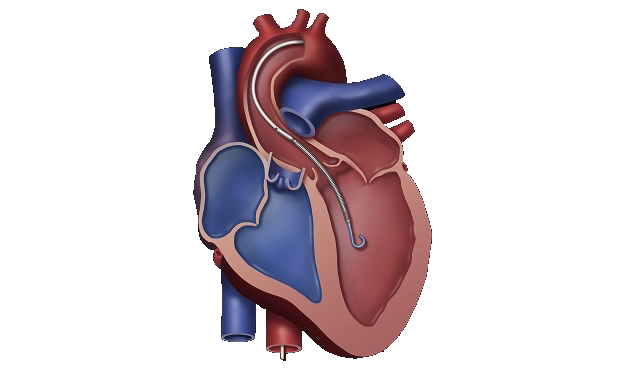 Complex high-risk indicated PCI — catheter inside the heart
