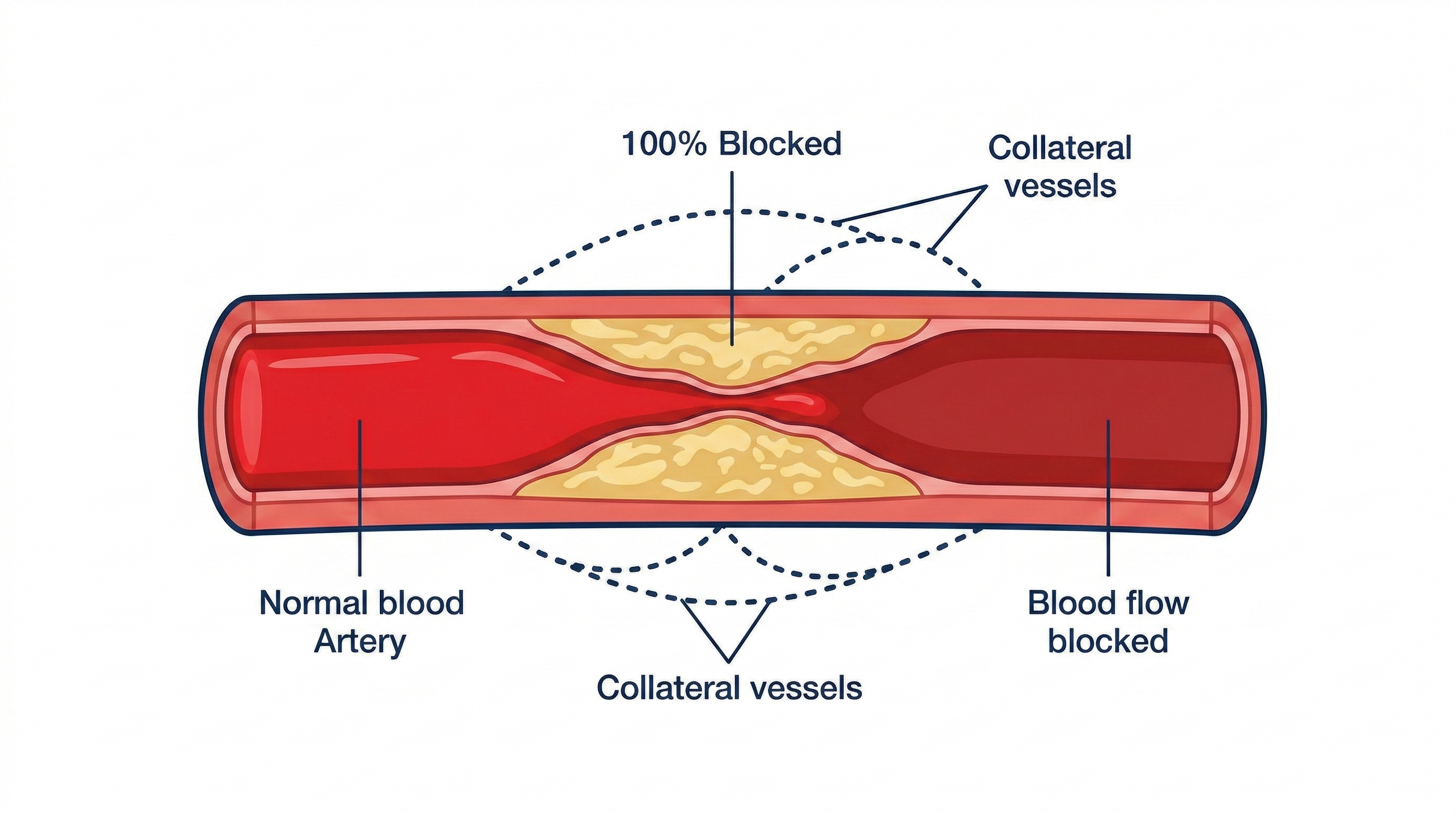 Chronic total occlusion — 100% blocked artery with collateral vessels