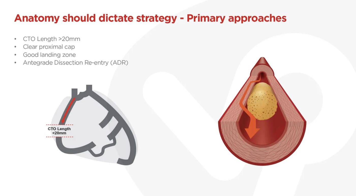Antegrade dissection re-entry: long CTO, clear cap, good landing zone