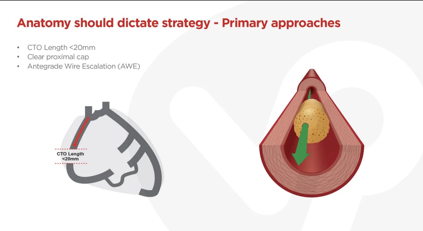 Antegrade wire escalation: short CTO, clear proximal cap