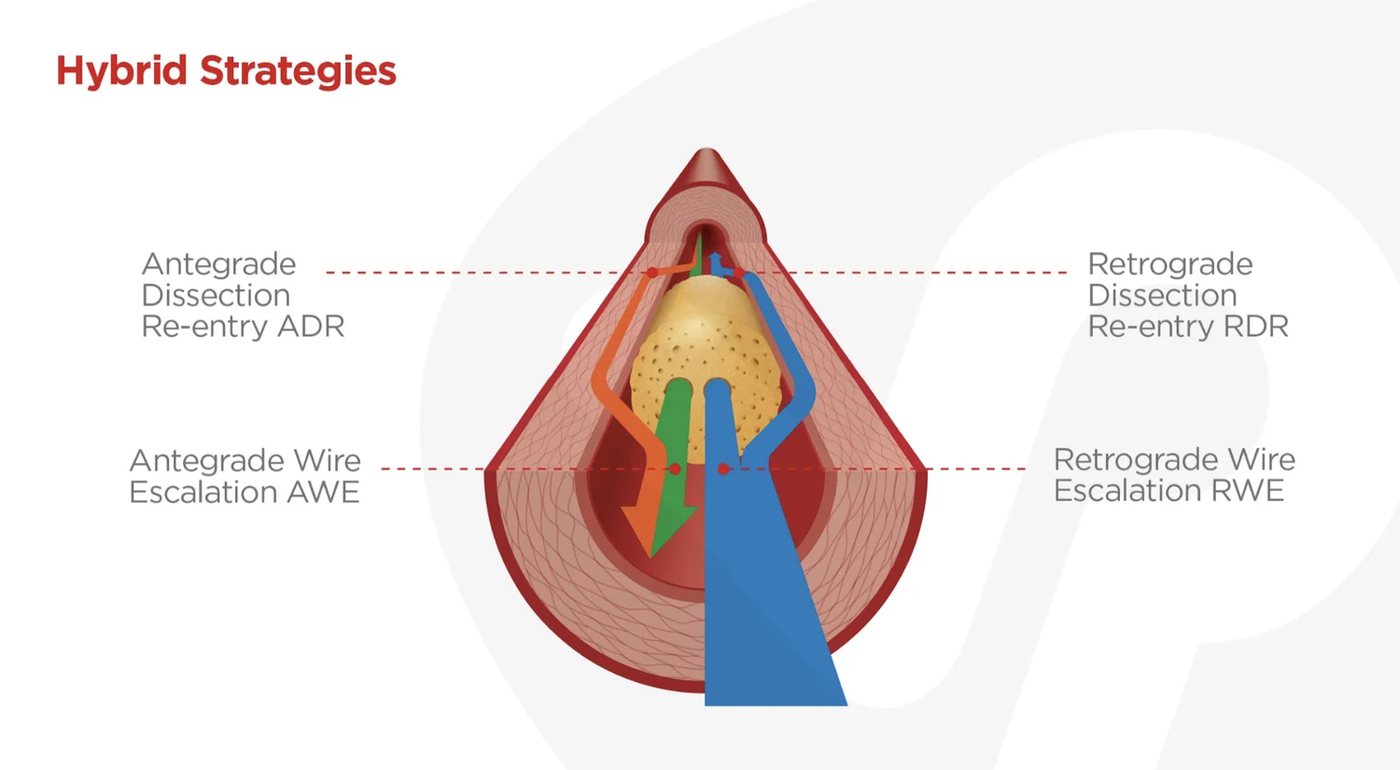 Cross-section of a CTO showing all four crossing strategies: AWE, ADR, RWE, RDR
