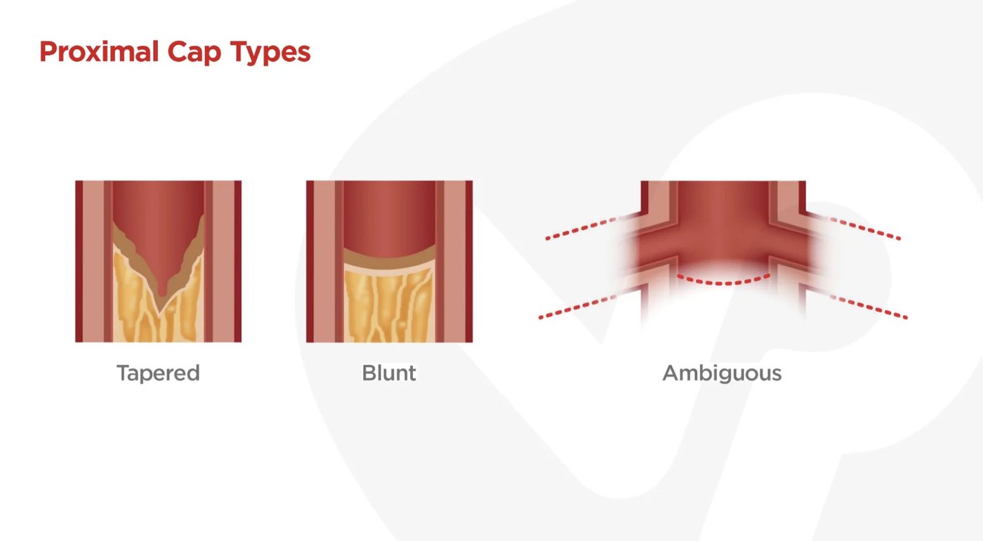 Proximal cap types: tapered, blunt, ambiguous