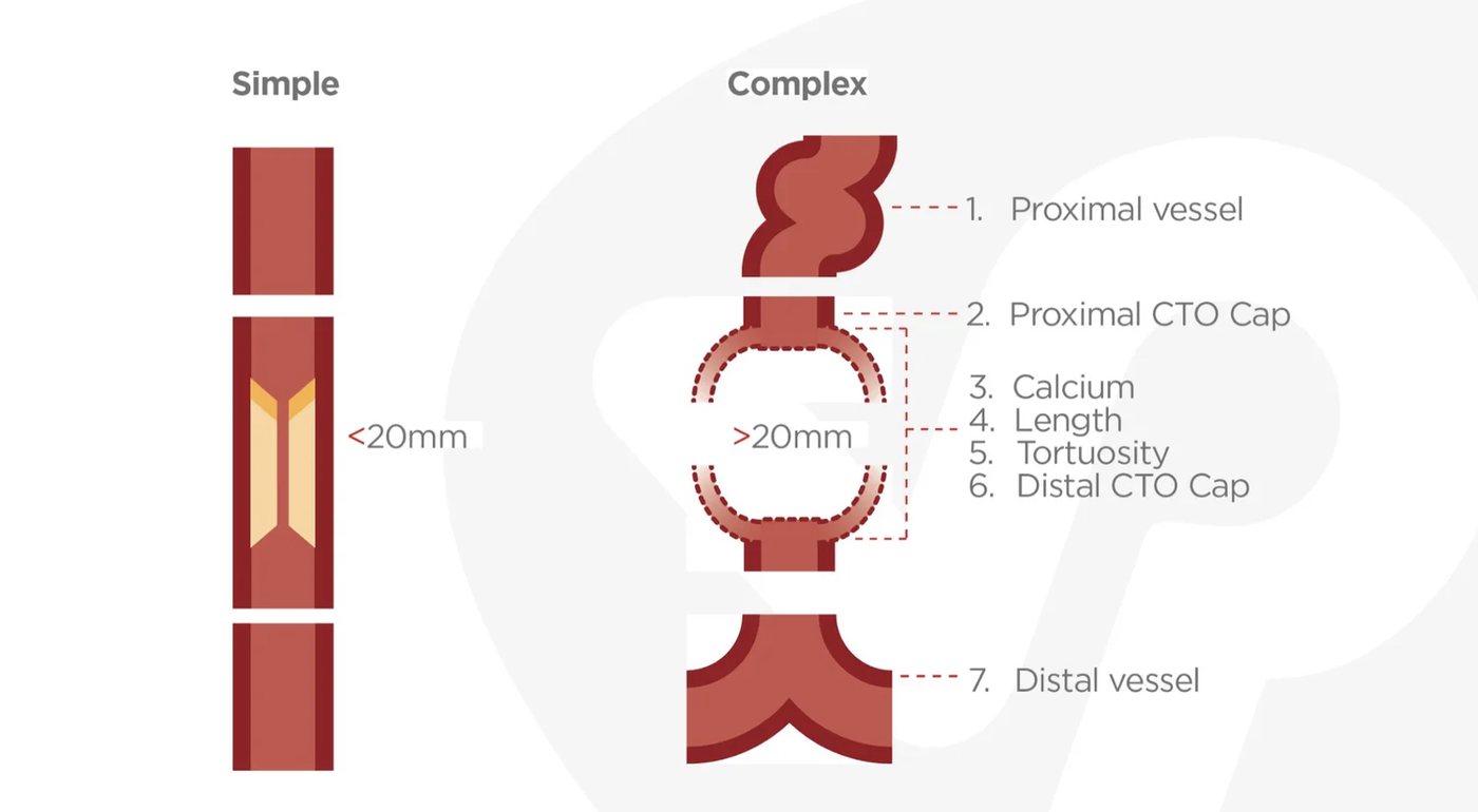 Simple versus complex CTO anatomy: the seven anatomic segments assessed