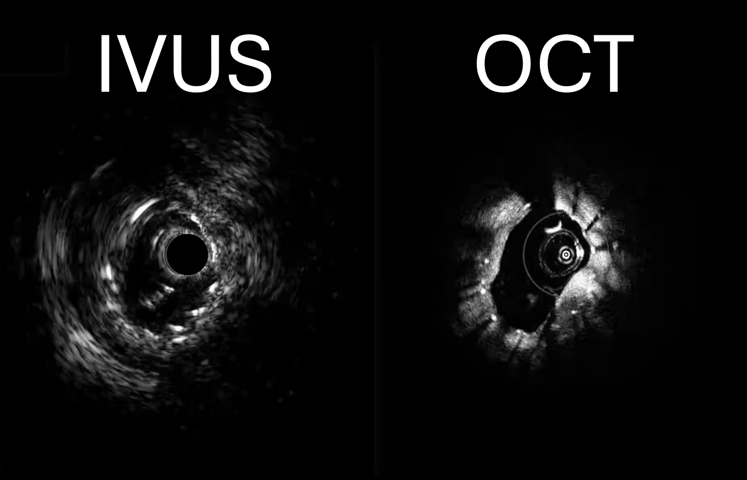 Co-registered IVUS and OCT imaging - Example 1