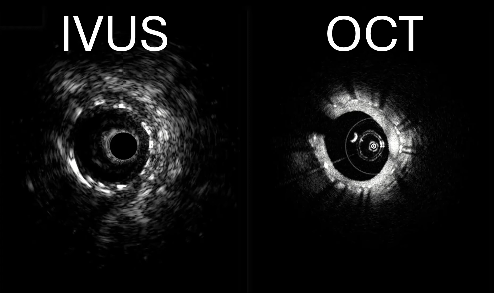 Co-registered IVUS and OCT imaging - Example 2