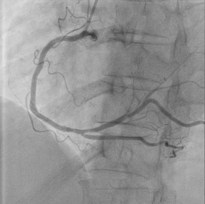 RCA CTO after PCI — restored flow