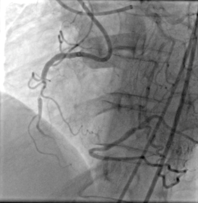 RCA CTO before PCI — complete occlusion