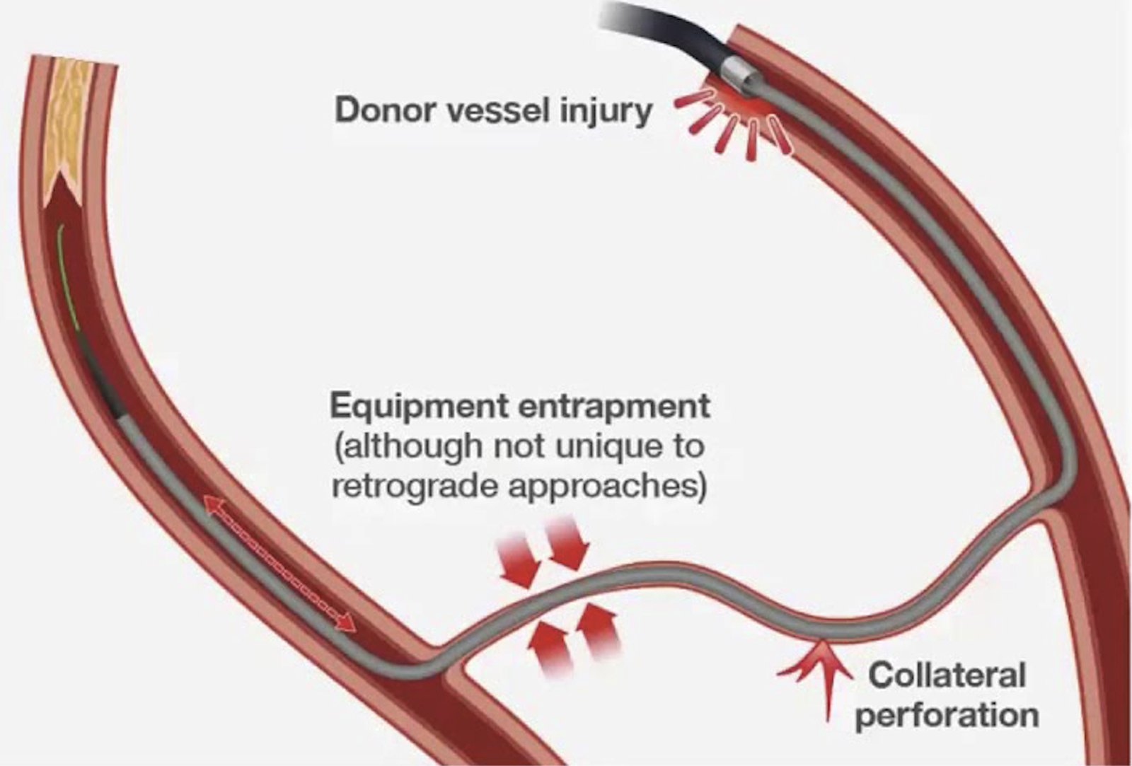 Diagram of retrograde-specific complications: donor vessel injury, collateral perforation, equipment entrapment