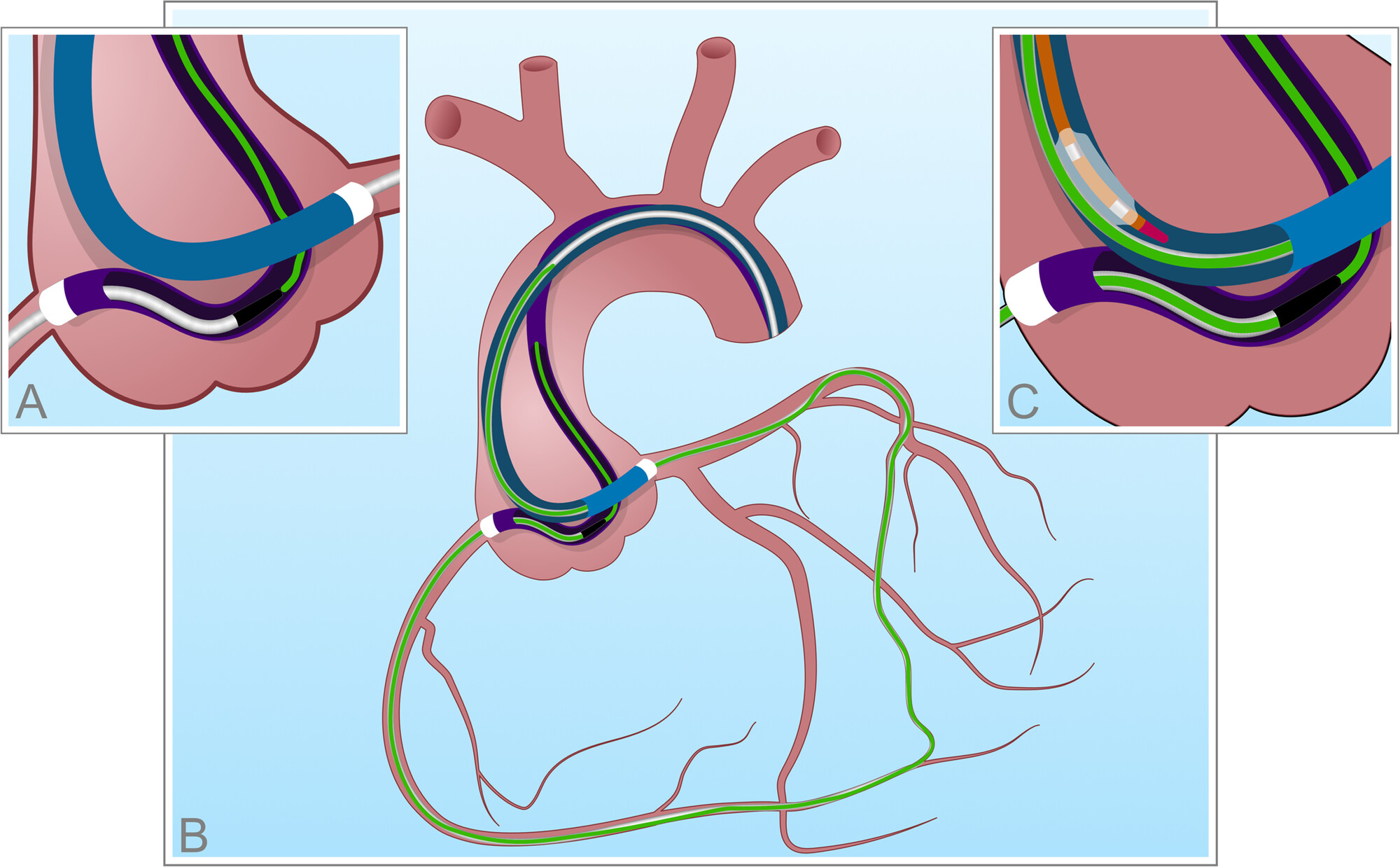Retrograde approach diagram: guidewire advanced through collateral vessels, snared and externalized to create a continuous rail