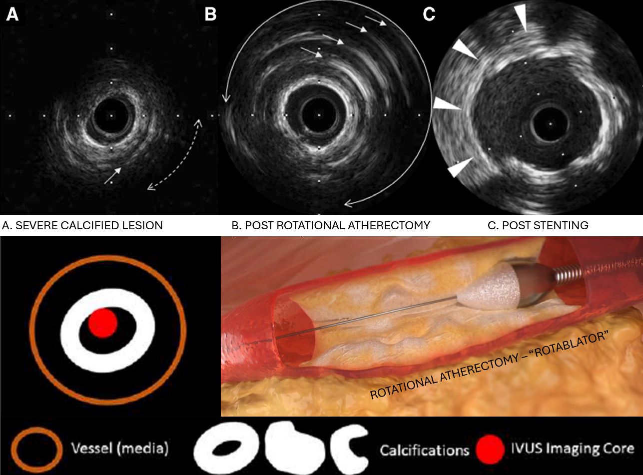 Rotational atherectomy with IVUS guidance for calcified lesion