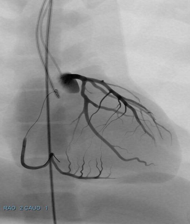 Simulator fluoroscopy: wire crossing the occlusion