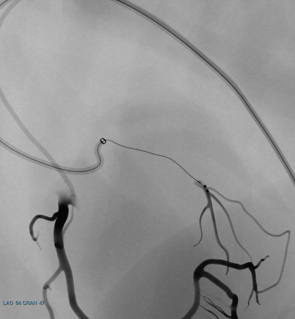 Simulator fluoroscopy: CTO re-entry device reopening the LAD
