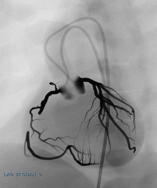 Dual injection: collaterals reveal the distal vessel