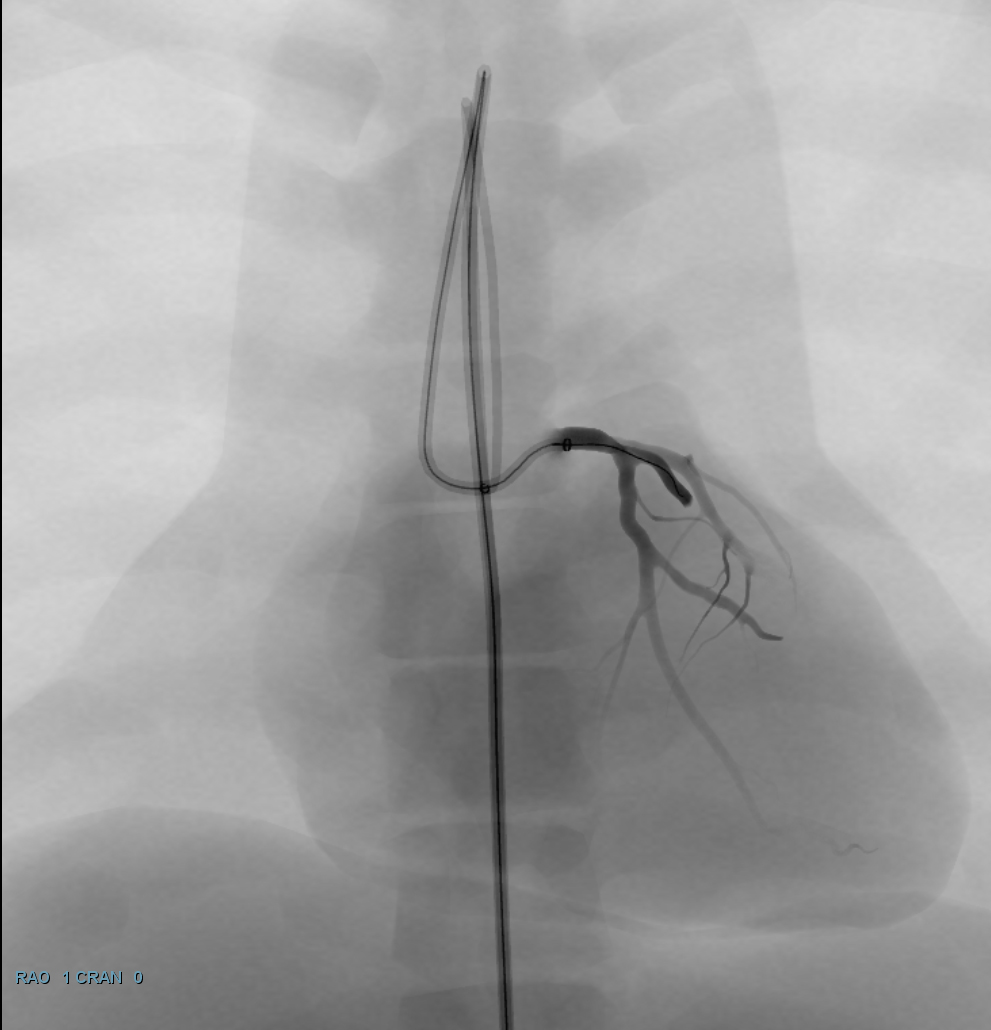 Simulator angiogram: LAD CTO
