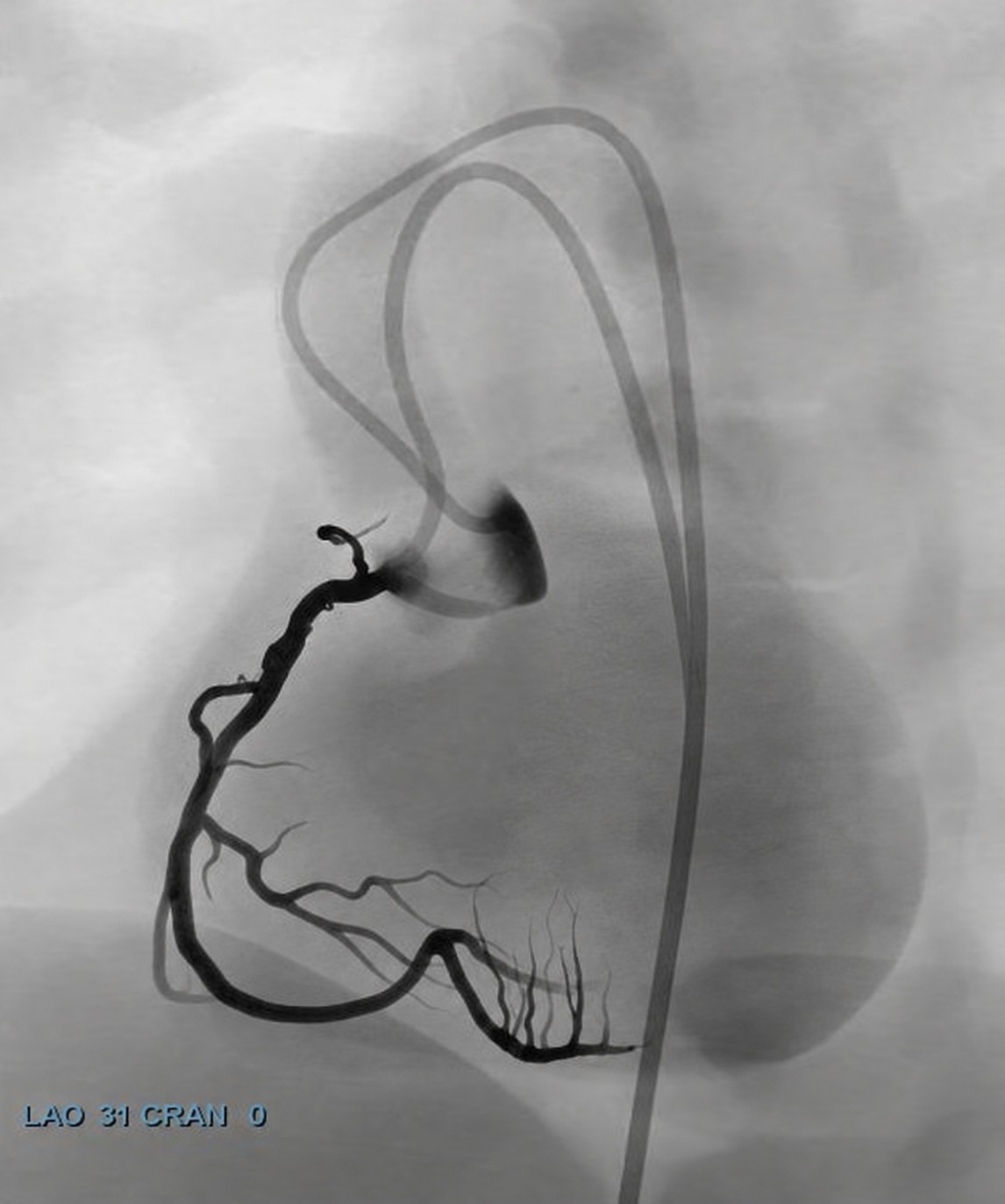 Final angiogram: right coronary artery fully open to the distal bed