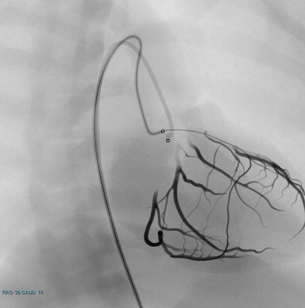 Simulator fluoroscopy: retrograde septal crossing