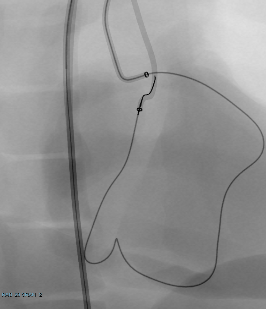 Simulator fluoroscopy: retrograde wire externalization