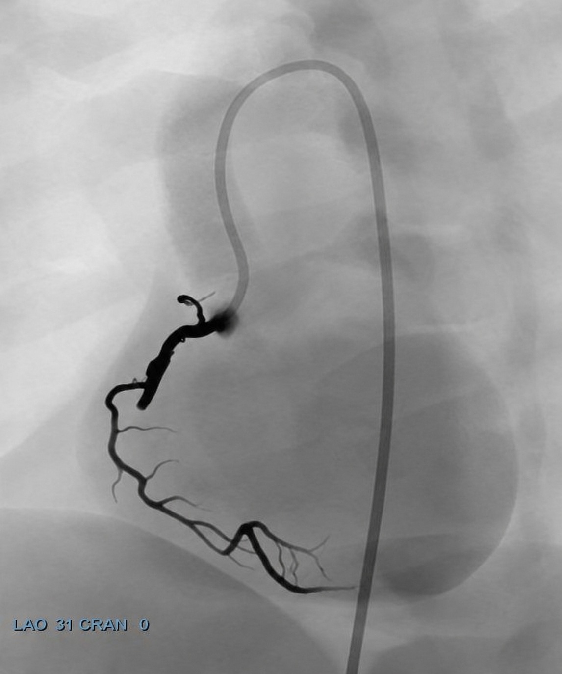 Single injection: contrast stops at the CTO, distal vessel invisible