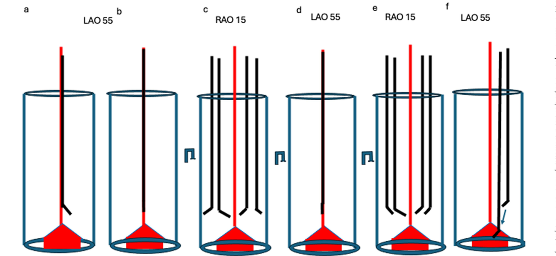 ZOLUTION six-panel sequence showing ZOV identification, tip straightening, secondary view check, 180 degree rotation if misaligned, and final puncture