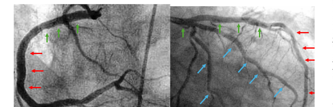 Two angiographic images annotated with red, green and blue arrows showing which fluoroscopic projections to use per coronary segment