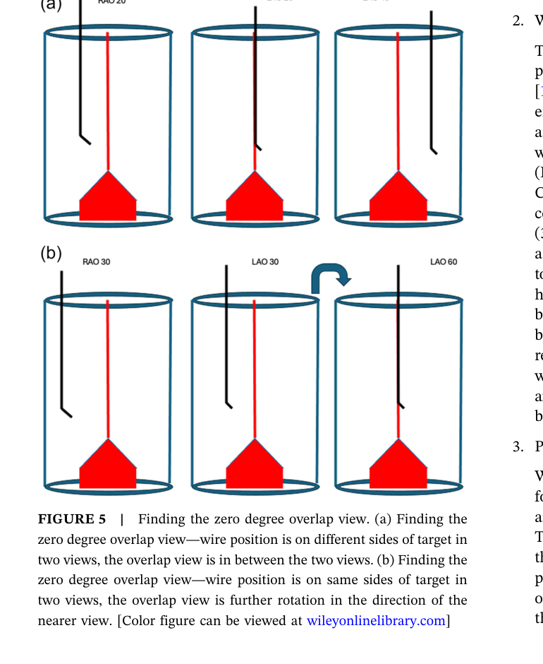 Two scenarios for finding the ZOV from two coronary views